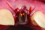 Figure 9 Stage 2 surgical uncovering of the implant with a crestal incision more to the palatal aspect of the ridge allowing greater tissue thickness on the facial aspect of the abutment. The patient’s pre-existing abutment was modified with flat subgingival contours to ensure stability of the new FGM.