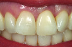 Figure 15 Four years post-insertion of the definitive restoration showing stability of the reconstituted soft tissue margin using the “implant decoronation” technique. Needless to say, the patient was extremely satisfied and pleased with the mid-term outcomes.
