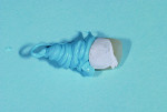 Figure 9 Disposable liner used prior to making a custom copy abutment.