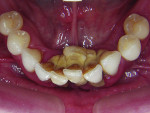 Figure 3 Calculus around these teeth presents an issue due to the bacteria associated with it. In itself, it may be considered as taking more of a passive than an active role in periodontal disease.