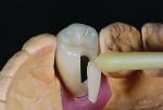 Figure 16 A screw-retained crown can be readily made esthetic by closing off the screw access channel with bonded porcelain inlays (Fig 16), which leads to a highly esthetic result and facilitates complete control of occlusion (Fig 17).