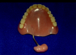 Figure 3 Contemporary SAP with maxillary complete denture retaining the speech bulb.