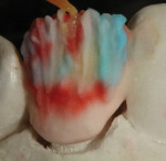 Figure 10. Additional translucency
was brushed between stain using
opalescence, TO.