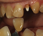 Figure 1 Dentin body shade A4 was selected
and an assessment was done of surrounding
dentition color.