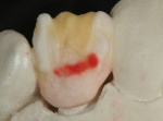 Figure 4 First porcelain was built up on mesial and distal middle 2/3 incisal aspects with translucent opal, light orange stain IV-5.