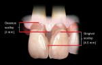 Figure 2  The average osseous scallop is 3 mm from facial to interproximal, and the average gingival scallop is 4.5 mm from facial to interproximal between natural teeth.