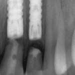 Figure 10  Adjacent implants placed in central and lateral position. Note excellent interproximal bone but minimal inter-implant distance.