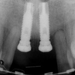 Figure 23  Implant placement.