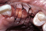 Figure 26  The use of a pediculated connective tissue graft to augment the soft tissue height.