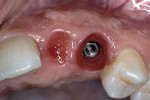 Figure 27  The lateral incisor implant has been put to sleep and the cuspid implant uncovered.
