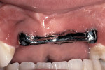 Figure 29  A patient with a very high lip line and a significant ridge defect following an auto accident. The bar is to retain a removable prosthesis.