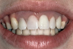Figure 30  A 16-year recall of the removable prosthesis with the labial flange extending under the patient’s high smile line.