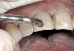 Figure 3  Using a micro etcher to lightly sand blast the surface of the prepared teeth before final adhesive procedures.