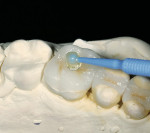 Figure 6  The onlay with a drop of the viscous modeling resin is placed on the occlusal. The brush is wetted with the resin, placed in contact with the occlusal resin, and the complex is light-cured.