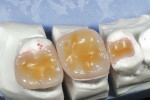 Figure 9  Sticky wax is placed on the occlusal surface of a quadrant of glass ceramic restorations.