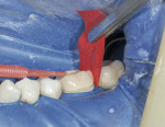 Figure 11  Using the attached nylon brush in conjunction with articulator tape helps to check interproximal contacts with hemostats.