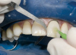 Figure 13  Using a fine metal finishing strip to adjust the contact before cementation.