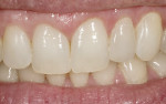 Figure 14  Veneer tried-in on tooth No. 10 with a clear try-in paste. Note that it is lower in value than the adjacent teeth.