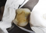Figure 19  An onlay preparation is isolated using plumbers tape. To help cement removal, dental tape can be placed below the margin as shown here on the distal.