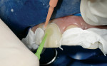 Figure 21  The excess composite is removed before cementation with a composite nylon brush.