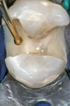 Figure 1  The open sandwich technique. The Class II interproximal box is partially restored with a glass-ionomer material leaving glass ionomer exposed to the oral environment in the gingival region to form the cervical seal. The restoration is compl