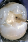Figure 2  The closed sandwich technique. The Class I cavity is partially restored with a base of glass-ionomer material, then covered and sealed with a resin composite.