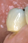 Figure 3  Preoperative view of a wedge-shaped carious cervical lesion on the mandibular right second bicuspid. Note the wear pattern on the buccal cusp.