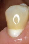 Figure 4  The initial caries control procedure provided removal of the infected dentin and a seal of the lesion, while remineralizing the affected dentin.
