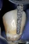 Figure 5a  A chamfer was placed along the occlusal margin.