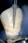 Figure 5b  A scalloped 0.5-mm bevel was placed to interrupt the straight line of the chamfer and to reduce the potential microleakage