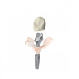 Implantology Dental System by Delcam