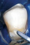 Figure 7a  The initial enamel layer of A-4 opaceous shaded composite resin was applied to the occlusal one half of the preparation with a long bladed composite instrument (A); and contoured and smoothed with a sable brush (B).