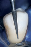 Figure 11a  The anatomic contour was accomplished with a 30-fluted needle-shaped finishing bur (A); the gingival area was contoured and finished using a 30-fluted tapered finishing bur (B).