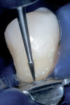 Figure 11a  The anatomic contour was accomplished with a 30-fluted needle-shaped finishing bur (A); the gingival area was contoured and finished using a 30-fluted tapered finishing bur (B).