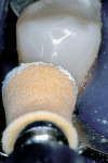 Figure 13  The high surface reflectivity of the restoration was rendered with a synthetic foam cup, aluminum oxide paste, and the incremental use of water
