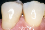 Figure 14  The completed restoration reveals the harmonious integration of resin-modified glass ionomer, composite resin, and tooth structure at the dentogingival complex.