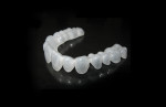 Figure 1 Kor-Seal trays fit precisely at the cervical gingival margin, sealing out destructive fluids and allowing the whitening gel to remain active for more than 6 hours.