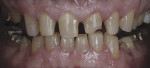 Figure 7 The affected teeth were prepared.
