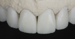 Figure 11 The full-contour anterior crown restorations were cut back slightly on the incisal portion to allow for artistic modification.