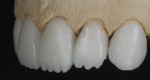 Figure 12 The full-contour anterior crown restorations were cut back slightly on the incisal portion to allow for artistic modification.