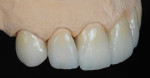 Figure 14 A series of IPS e.max Ceram powders were applied to complete the incisal characterization, after which the crowns were fired.