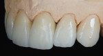 Figure 15 A series of IPS e.max Ceram powders were applied to complete the incisal characterization, after which the crowns were fired.