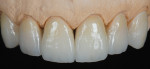 Figure 16 A series of IPS e.max Ceram powders were applied to complete the incisal characterization, after which the crowns were fired.