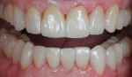 Figure 17 The definitive crowns were tried in, cleaned with Ivoclean, and cemented with Variolink luting composite according to the manufacturer's instructions.