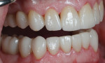 Figure 18 The definitive crowns were tried in, cleaned with Ivoclean, and cemented with Variolink luting composite according to the manufacturer's instructions.