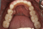Figure 20 IPS e.max Press veneers were placed on teeth No. 22 through No. 27, and a NobelActive implant was inserted for tooth No. 3.
