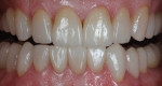 Figure 22 IPS e.max Press veneers were placed on teeth No. 22 through No. 27, and a NobelActive implant was inserted for tooth No. 3.