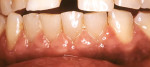 Figure 1 Case 1 pretreatment view prior to tissue removal with CO2 laser.