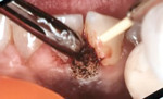 Figure 2 Note that an instrument is placed between the soft tissue and the teeth due to the aggressive interaction of CO2 with hydroxyapatite.