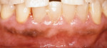 Figure 3 Case 1 at 3 weeks post-treatment.